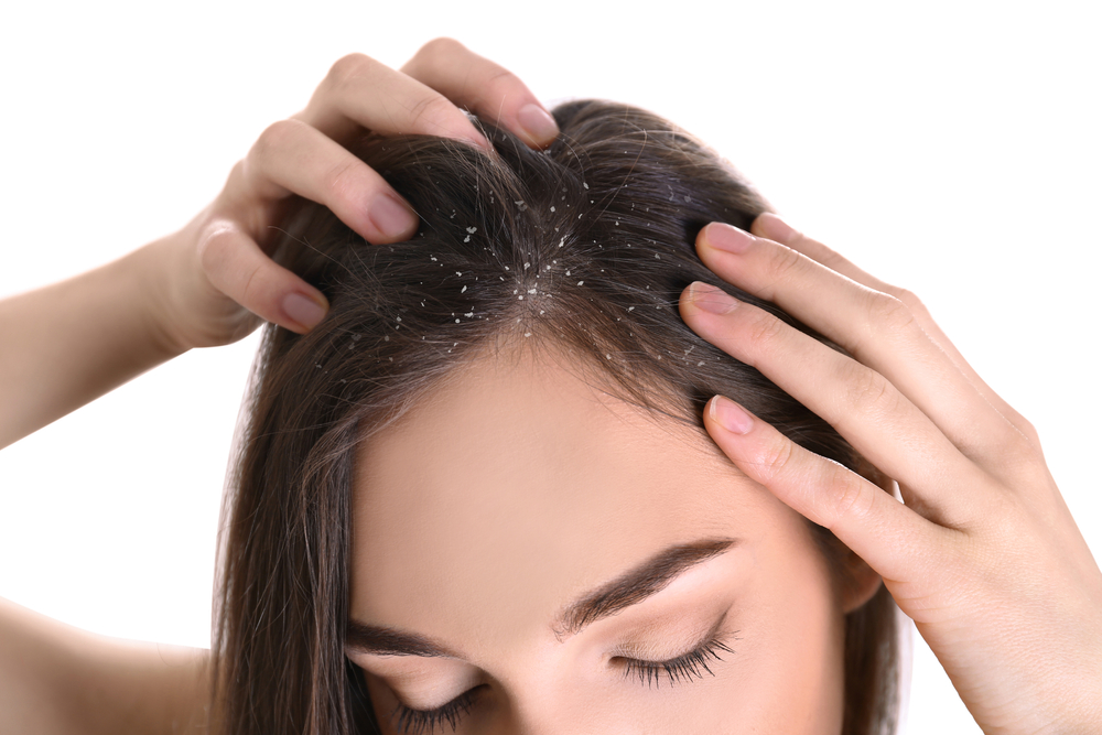 Woman,With,Dandruff,In,Her,Hair,On,White,Background,,Closeup||التخلص من قشرة الشعر