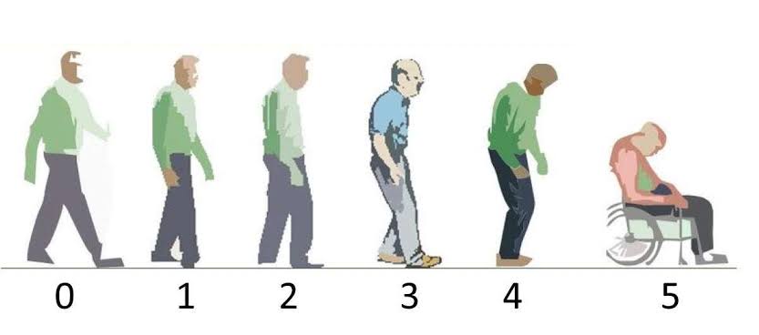 كم عدد مراحل مرض الباركنسون؟ ||كم عدد مراحل مرض الباركنسون؟ 