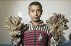 متلازمة الرجل الشجرة