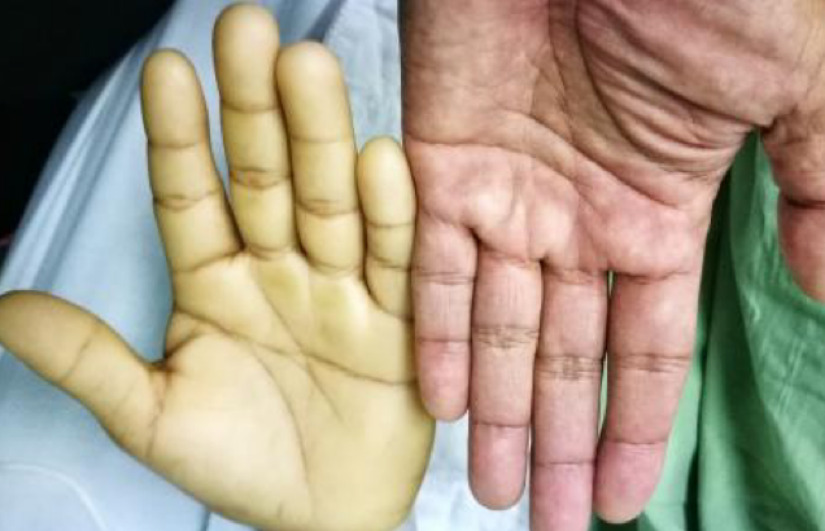 فقر الدم الانحلالي